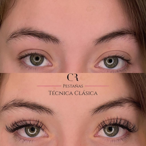 Extensiones Técnica Clásica